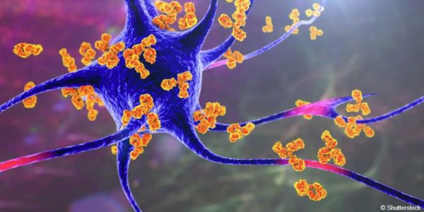 Image related to Simple scoring system could help clinicians identify possible cases of NMDAR-antibody encephalitis