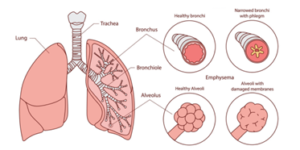 A diagram of the lungs with a cross section and description of certain areas.