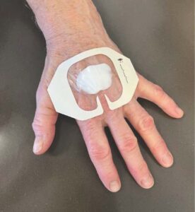 A picture of a hand with some cream under a clear plaster