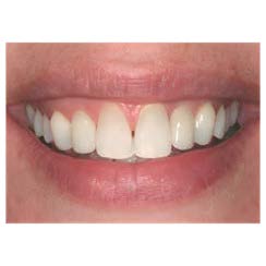 A picture of a nice smile showing the top row of teeth